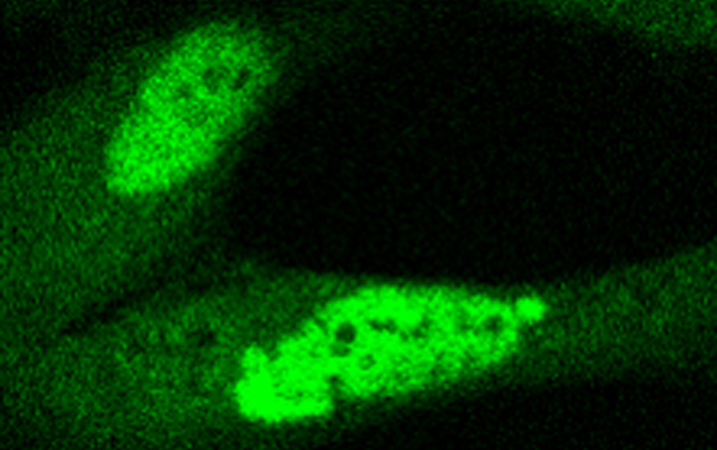Discovered a key alteration in the genes involved in the development of Cornelia de Lange syndrome