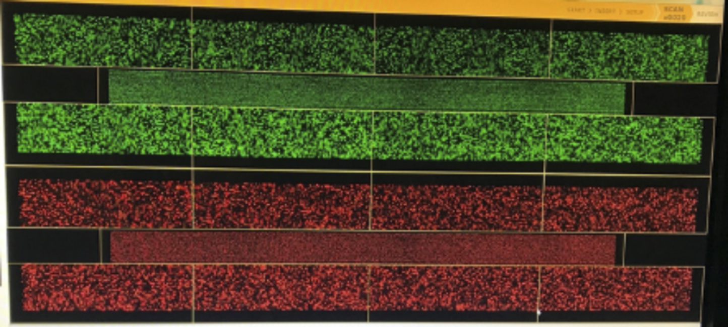 Discovered the explanation of the patients with “lazarus-like” cancer
